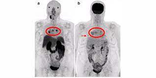 The Exploration Of Psma Pet As A Possible Theranostic Agent In Thyroid Cancer Ucsf Radiology