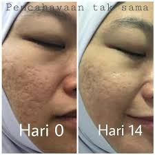 Parut terbentuk dari proses penyembuhan luka secara semulajadi. Petua Hilangkan Bekas Jerawat Hitam Secara Semulajadi