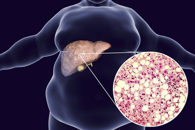 Résultat de recherche d'images pour "liver fat""
