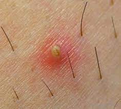 Find out how to get rid of ingrown hair. What Is The Difference Between An Ingrown Hair And A Boil