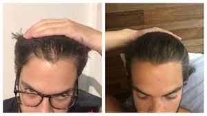 The benefits of finasteride will stop if the medication is discontinued. 8 Months Of Finasteride Keep Going For The Rest Of My Life Malehairadvice