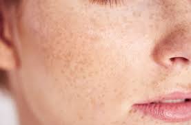 Image result for Hyperpigmentation