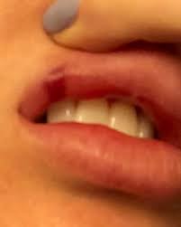 A blood blister is a type of blister that forms when subdermal tissues and blood vessels are damaged without piercing the skin. Blood Blister After Lip Filler Juvaderm Do I Need To Be Worried Photo