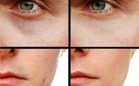 Top 3 best concealer for dark spots reviews 1. Best Concealers For Men Makeup For Guys To Cover Acne And Circles Spy