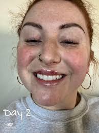 My Lip Filler Journey: The First Week of Transformation