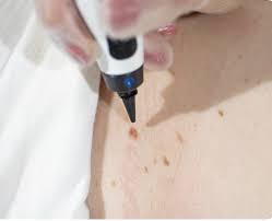 Image result for Cryotherapy