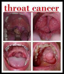 Hpv Virus And Neck Cancer Hpv Infection Head And Neck Cancer