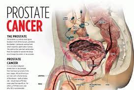Normally, prostate cancer grows very slowly and the symptoms caused by it are hardly noticeable. Prostate Cancer What Every Man Should Know Vanguard News