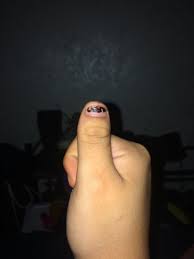 Check spelling or type a new query. I Have Really Wide Thumbs And I Would Like To Get It Fixed Is There A Surgery That Can Fix That Photo
