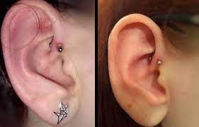 Piercing Bump 6 Ways To Get Rid Of Cartilage Or Nose Keloid Blister