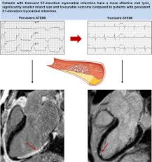 Image result for ST Elevation