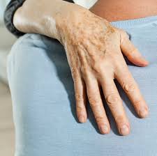 Random orange spots on hands. 6 Ways To Get Rid Of Age Spots On Your Hands Say Dermatologists