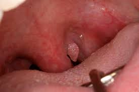 Image result for papillomavirus tongue)