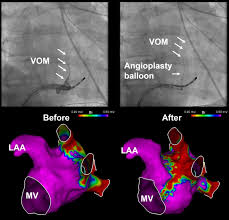 Joe edward jackson, 83, of whitney, texas, was embraced by his lord and savior jesus christ, on march 9, 2021. Impact Of Vein Of Marshall Ethanol Infusion On Mitral Isthmus Block Circulation Arrhythmia And Electrophysiology