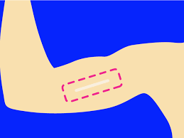 Check spelling or type a new query. Nexplanon 5 Things To Know About The Birth Control Implant Self