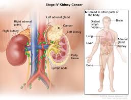 After being diagnosed with kidney cancer, questions about treatment may not be easy to remember. Kidney Renal Cell Cancer Hematology Oncology Associates Of Cny