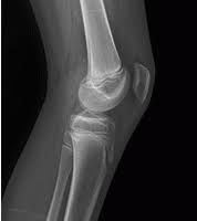 What Is Patellofemoral Pain Syndrome Orthocarolina