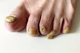 Image result for mykoza nehtů