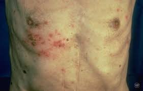 Image result for herpes zoster