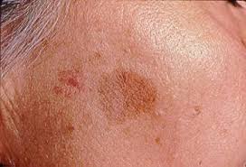 Image result for Solar Lentigo