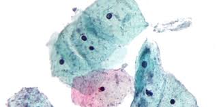 Image result for trichomonas images