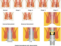 Image result for Hemorrhoid