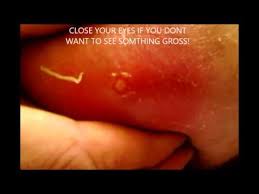 The black widow spider rarely bites people, but when it does, its venom can cause an unpleasant what happens after a black widow spider bite? Black Widow Bite Popped By Murphy45inc Graphic Youtube