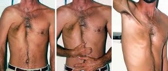 Poland syndrome (also poland's syndrome, poland's syndactyly, poland sequence, and poland's anomaly) is a rare birth defect characterized by underdevelopment or absence of the chest muscle (pectoralis) on one side of the body, and usually also webbing of the fingers (cutaneous syndactyly). Poland S Syndrome Thoracic Key