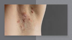 When the treatment is over, aloe vera will be applied. Hidradenitis Suppurativa And Laser Hair Removal Urbana