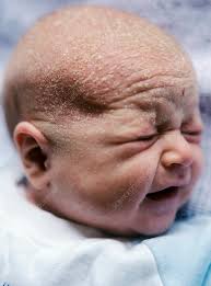 Image result for Cradle Cap