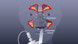 Nasennebenhohlenentzundung Sinusitis Focus Arztsuche