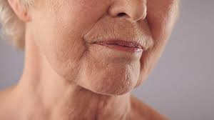 Image result for Lip Cancer