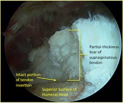 Double Row Repair Technique For Bursal Sided Partial Thickness Rotator Cuff Tears Arthroscopy Techniques