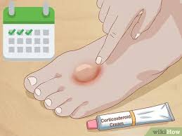 This explains the term shingles, which comes from the latin word for belt. 4 Ways To Get Rid Of Poison Ivy Rashes Wikihow