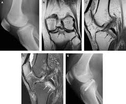 Image result for PCL Sulcus Test