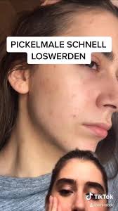 In letzter zeit bekomme ich total viele pickel. Emira Glowupwithemyrah Profil Pinterest