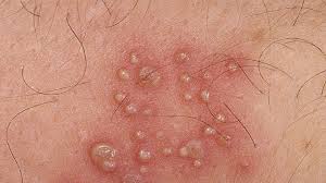 You can minimize the risk of ingrown pubic hair by treating the pubic area before hair removal. What To Use On Ingrown Pubic Hairs