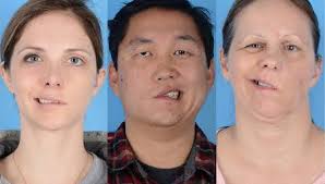 However, they aren't the same thing. Bell S Palsy Causes Treatment And Symptoms