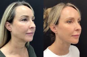 Cirugía Plástica Facial Antes y Después