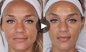 Thread lift solves this problem quickly and without pain thanks to the light lift, excellence and nano lines, developed by aptos. Aafe Snatched Millennial Ponytail Fox Lift Baby Boomer Eyebrow Lift With Botox Fillers Threads Aafe American Academy Of Facial Esthetics