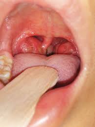 Image result for Tonsillitis