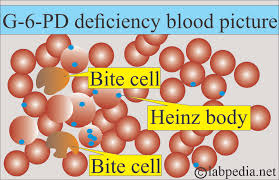 Image result for G6PD Deficiency Detection