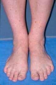 Palpable purpura is purpura than can be felt, due to inflammation of the blood vessels (vasculitis) Henoch Schonlein Purpura Johns Hopkins Vasculitis Center