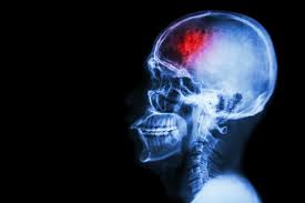 Quando isso acontece, a parte dilatada geralmente apresenta uma parede mais fina e. 5 Sintomas De Aneurisma Cerebral Ou Da Aorta Tua Saude