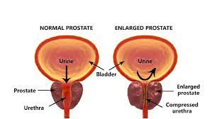 A cell's dna contains the instructions that tell a cell both prostate cancer and its treatment can cause urinary incontinence. Prostate Cancer A Guide For Aging Men Updated For 2021