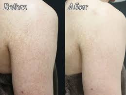 毛孔 性 苔 癬 レーザー 治療 料金