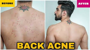 If you have acne on your back—or bacne as some people call it—you don't have to wait for it to clear on its own. How To Remove Back Acne Fast Men Women Natural Pimples Back Acne Treatment Dark Spots Hindi Youtube