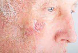 Piasecki personally performs all treatment options based on indications and patient needs; Mohs Surgery Recovery Aftercare Instructions Cost Pictures