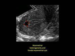 Adenomyosis Adenomyosis And Pregnancy Ivf1