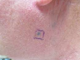 Image result for Blue Nevus